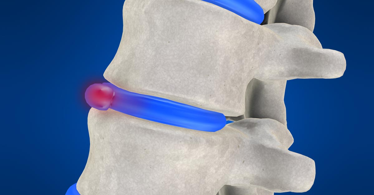 Burke non-surgical disc herniation treatment