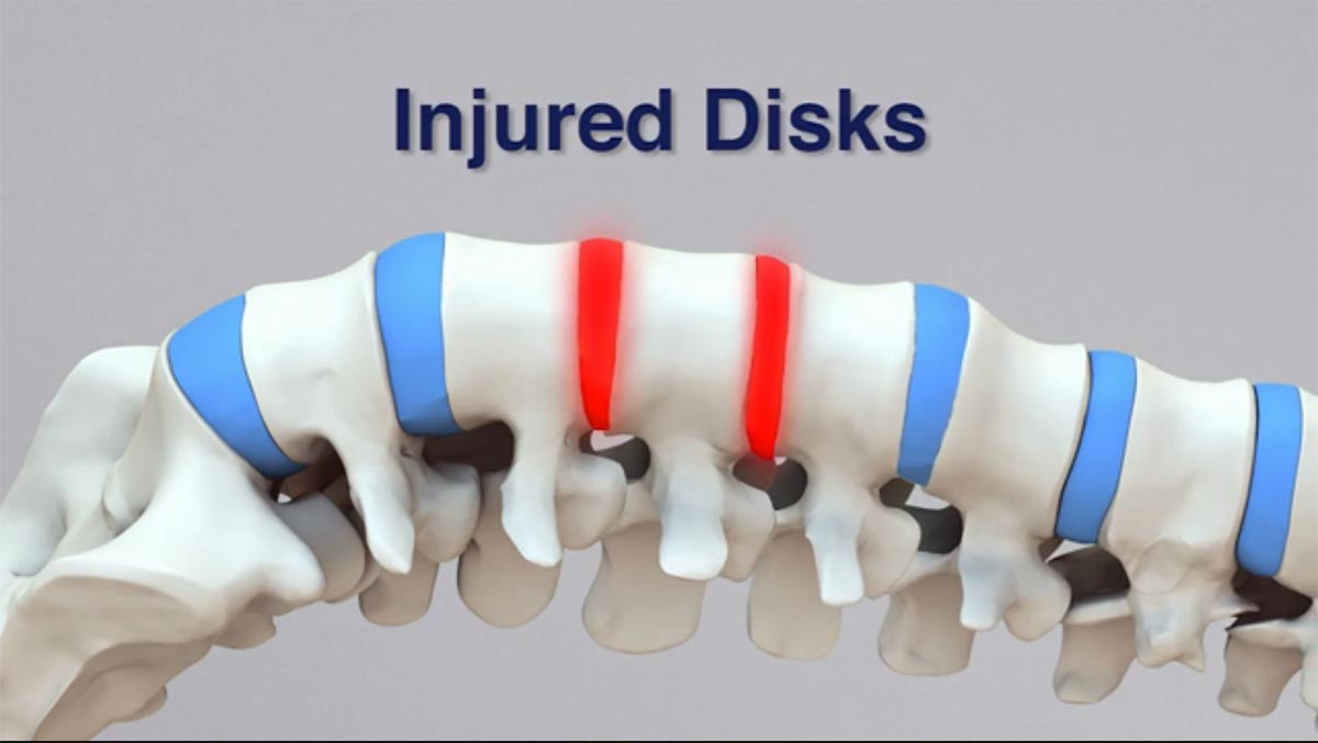 Burke non-surgical spinal decompression